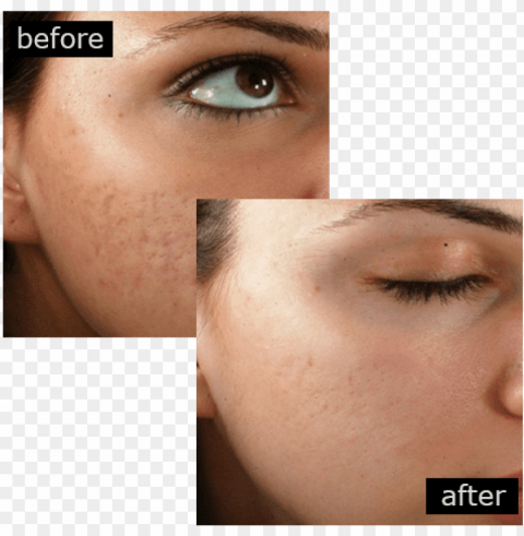 acne scar removal with outstanding results - philings before and after High Resolution PNG Isolated Illustration