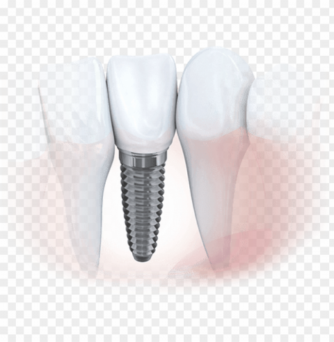 animation of implant supported dental crown - dental implant PNG Image with Transparent Isolated Graphic Element