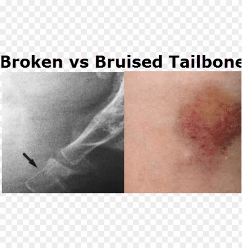 bruised tailbone vs broken tailbone - bruised tailbone PNG with clear background set PNG transparent with Clear Background ID f01dfb80