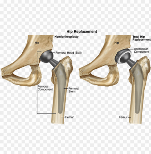 hemiarthroplasty vs total hip replacement PNG graphics for presentations