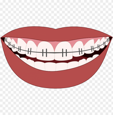 orthodontics smile teeth dentist - mouth braces clipart PNG Graphic with Transparent Background Isolation