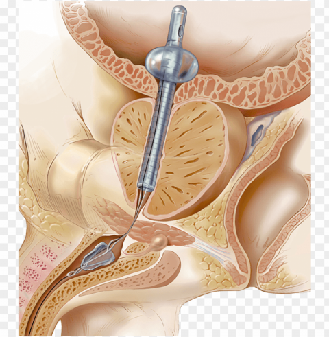 reatly preferred by patients over catheterization - catheter alternative PNG cutout