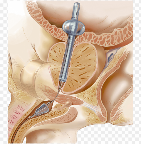 reatly preferred by patients over catheterization - catheter alternative PNG cutout PNG transparent with Clear Background ID d65ecce6