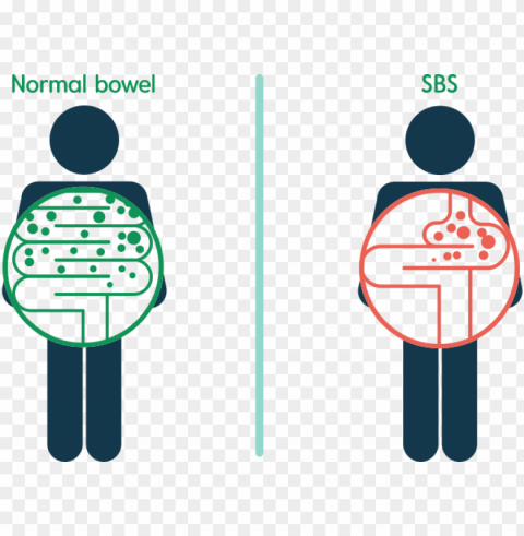 whereas food and liquid remain in a normal bowel for - short bowel syndrome Clear PNG graphics