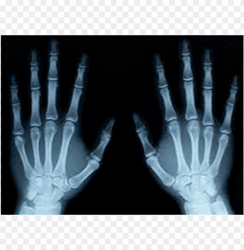x-ray of both hands PNG Isolated Object with Clarity